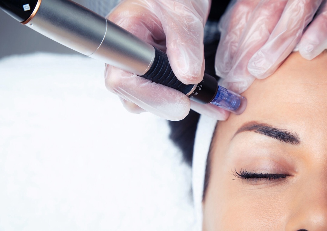 Microneedling at Vesna Beauty Spa